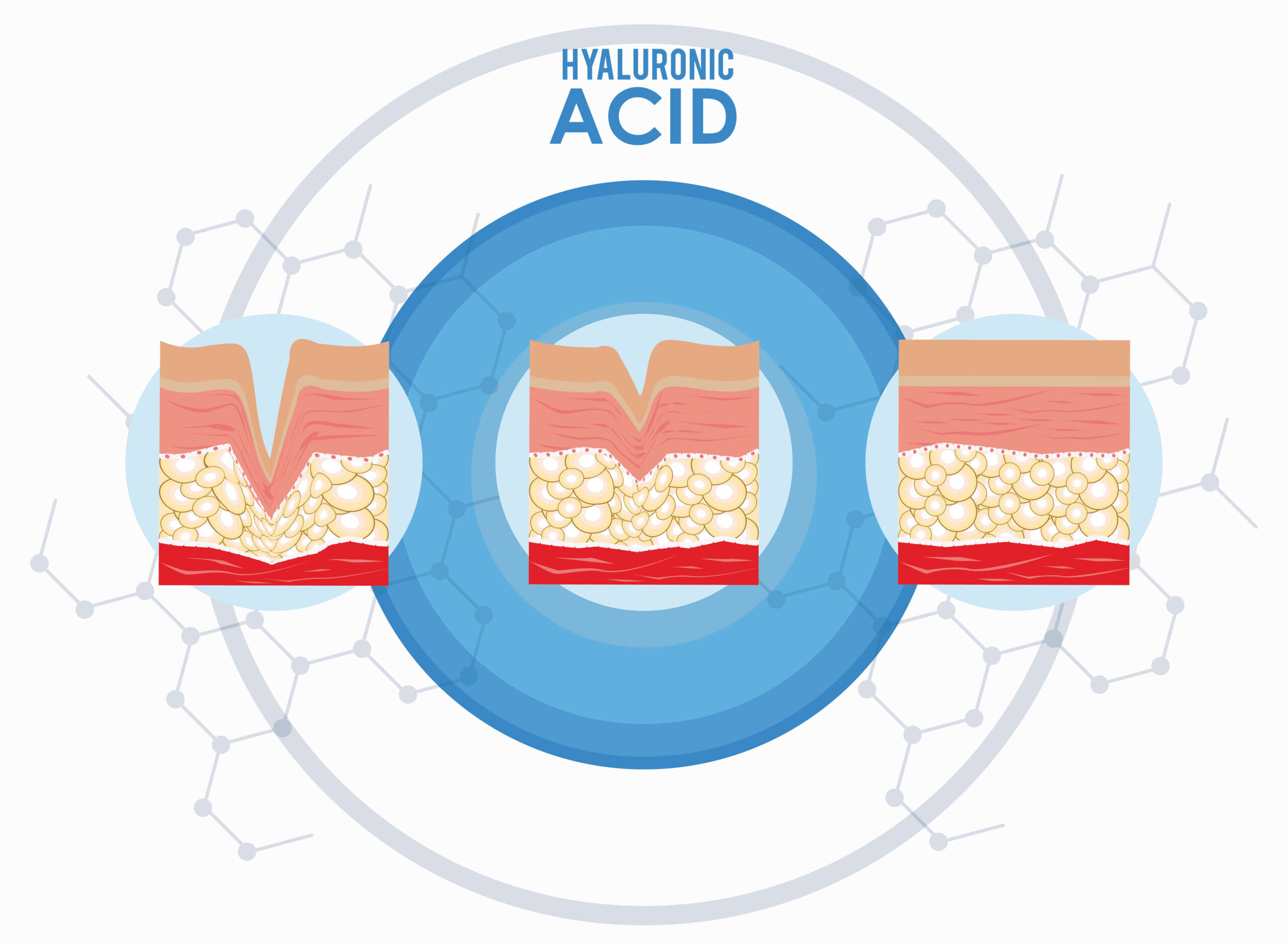 Hyaluronic Acid in Skincare